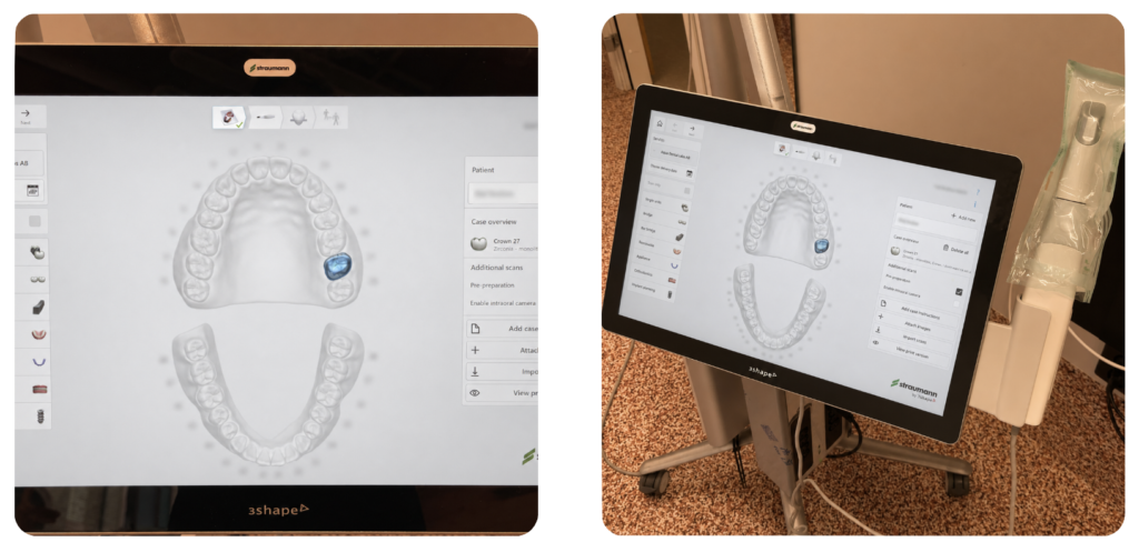Prescan med intraoral scanner inför kronpreparation - digital scanning av över och underkäke för tandsköterskor.