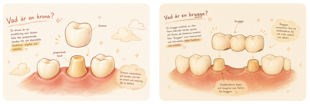 Illustration av krona och bro vid kronpreparation och bropreparation för tandsköterskor, med preparerade tänder och färdiga protetiska arbeten.