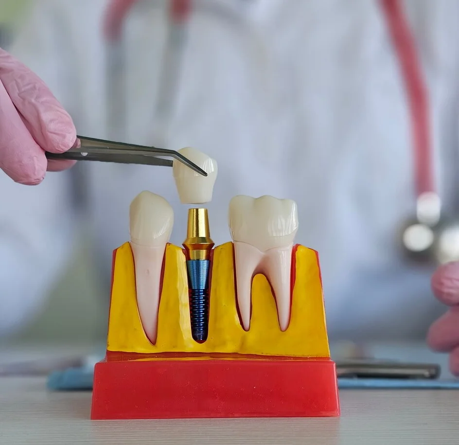 Utlämning av implantatkrona steg för steg – guide för tandsköterskor (med bilder & lathund)