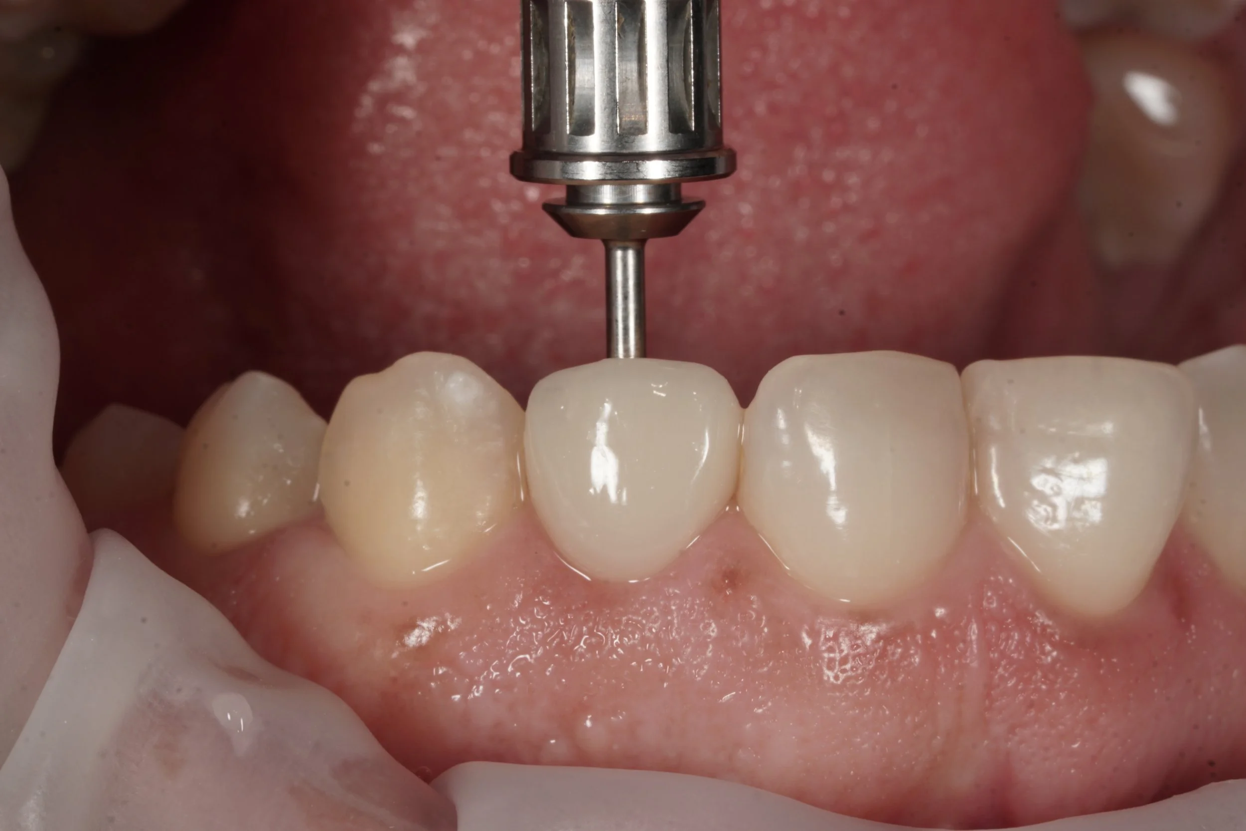 Digitalt avtryck för implantatkrona steg för steg – guide för tandsköterskor