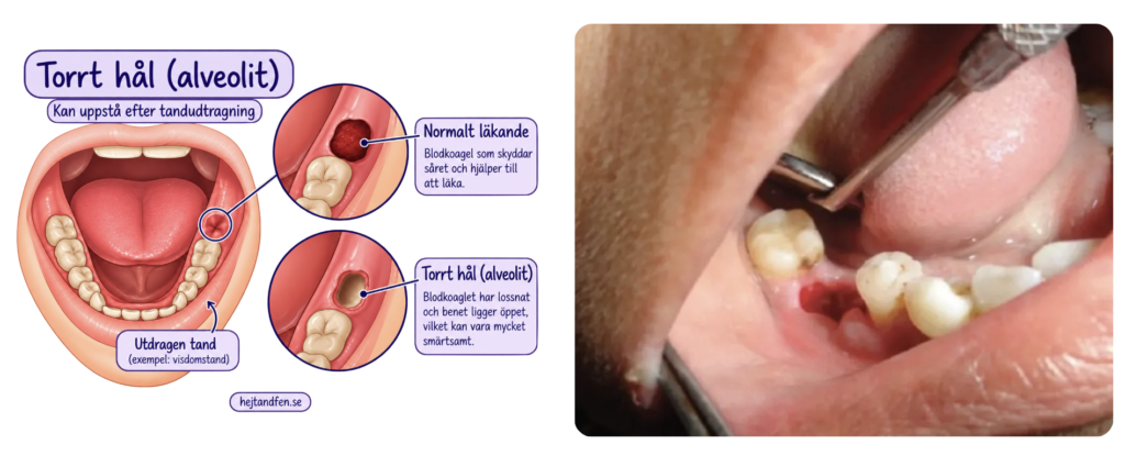 Illustration av alveolit (dry socket) efter tandutdragning som visar skillnaden mellan normal sårläkning med ett skyddande blodkoagel och en tom tandhåla där benet kan vara blottat.
